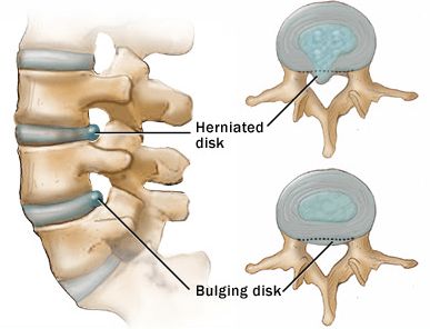 Back Pain Treatment<br />
